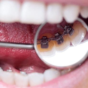 Orthodontie invisible